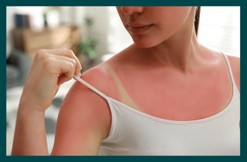 How to heal sunburn: GP-approved tips