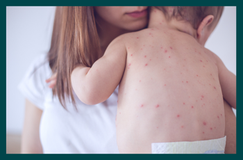 What is measles